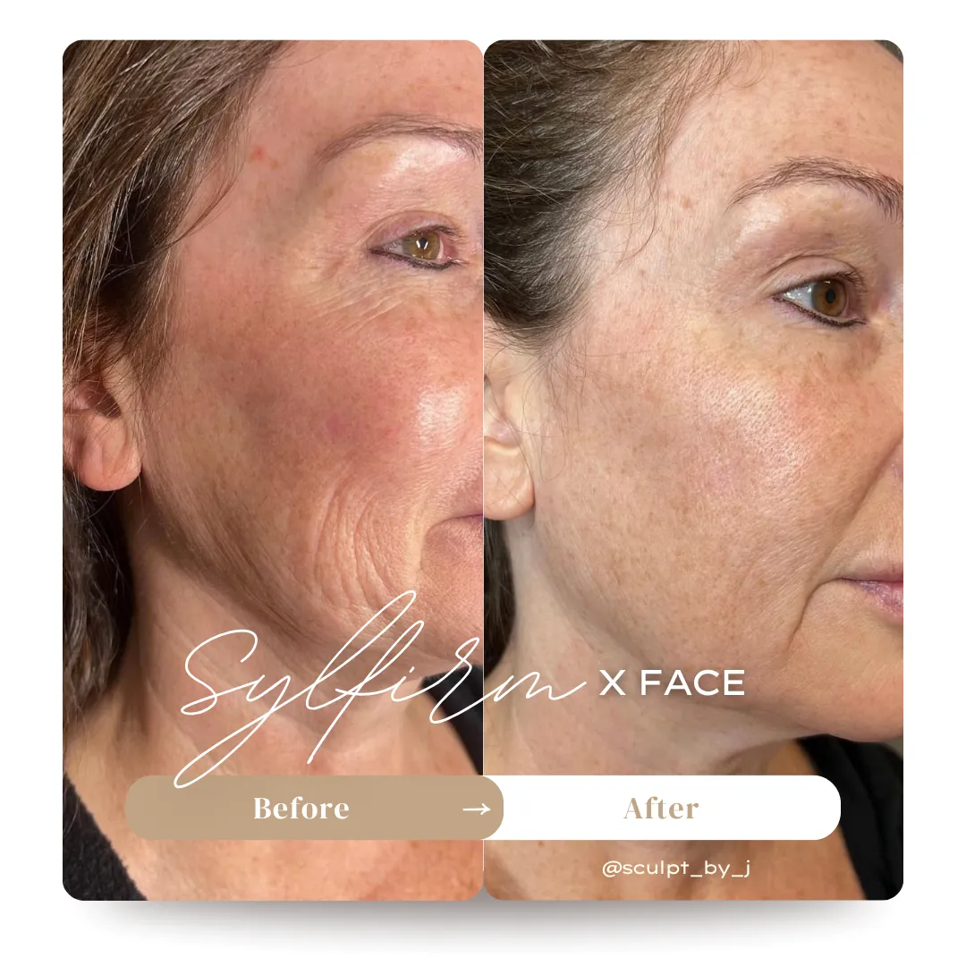 Fine Lines and Texture Refinement