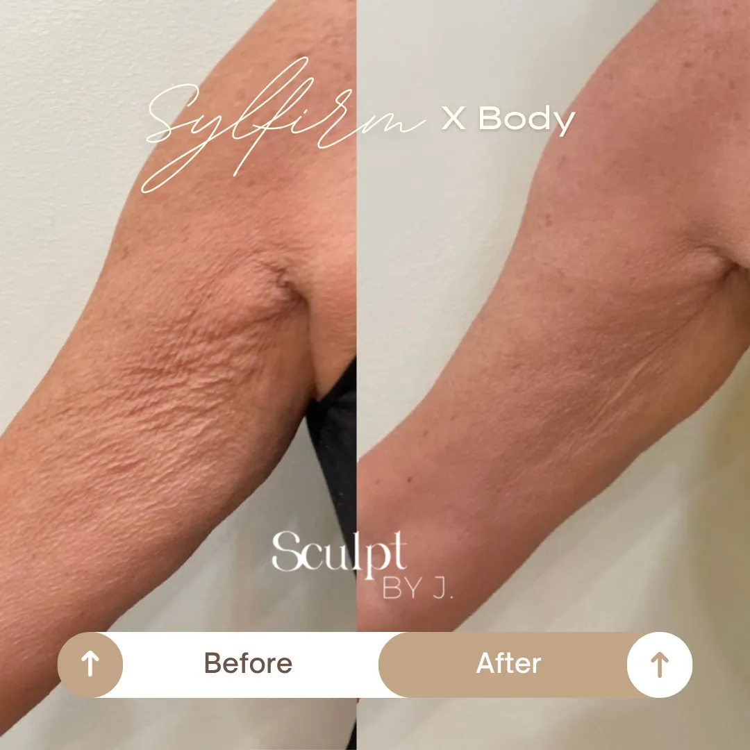 Under-Arm Smoothing and Firming