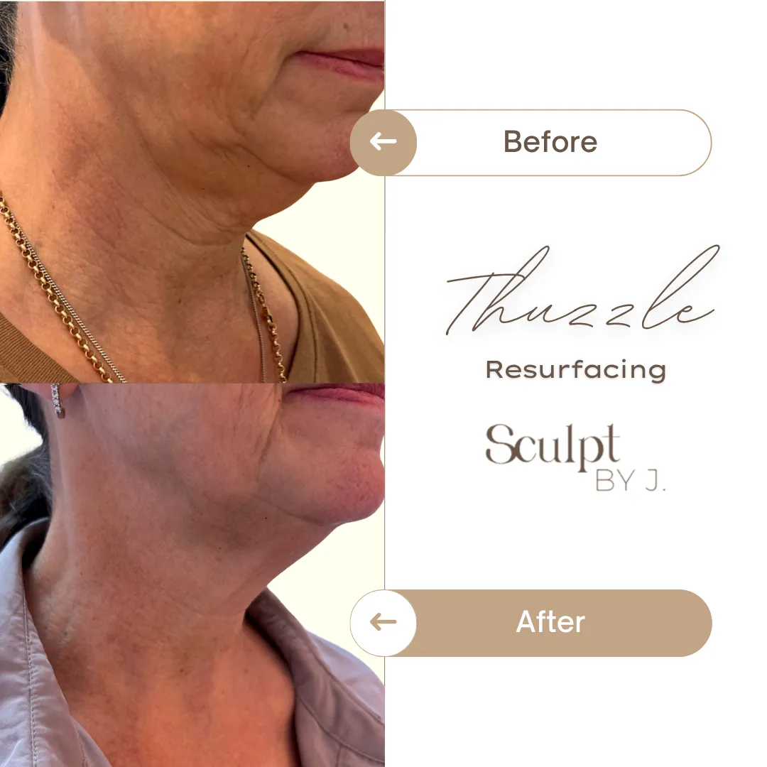 Deep Lipolysis Jawline Result