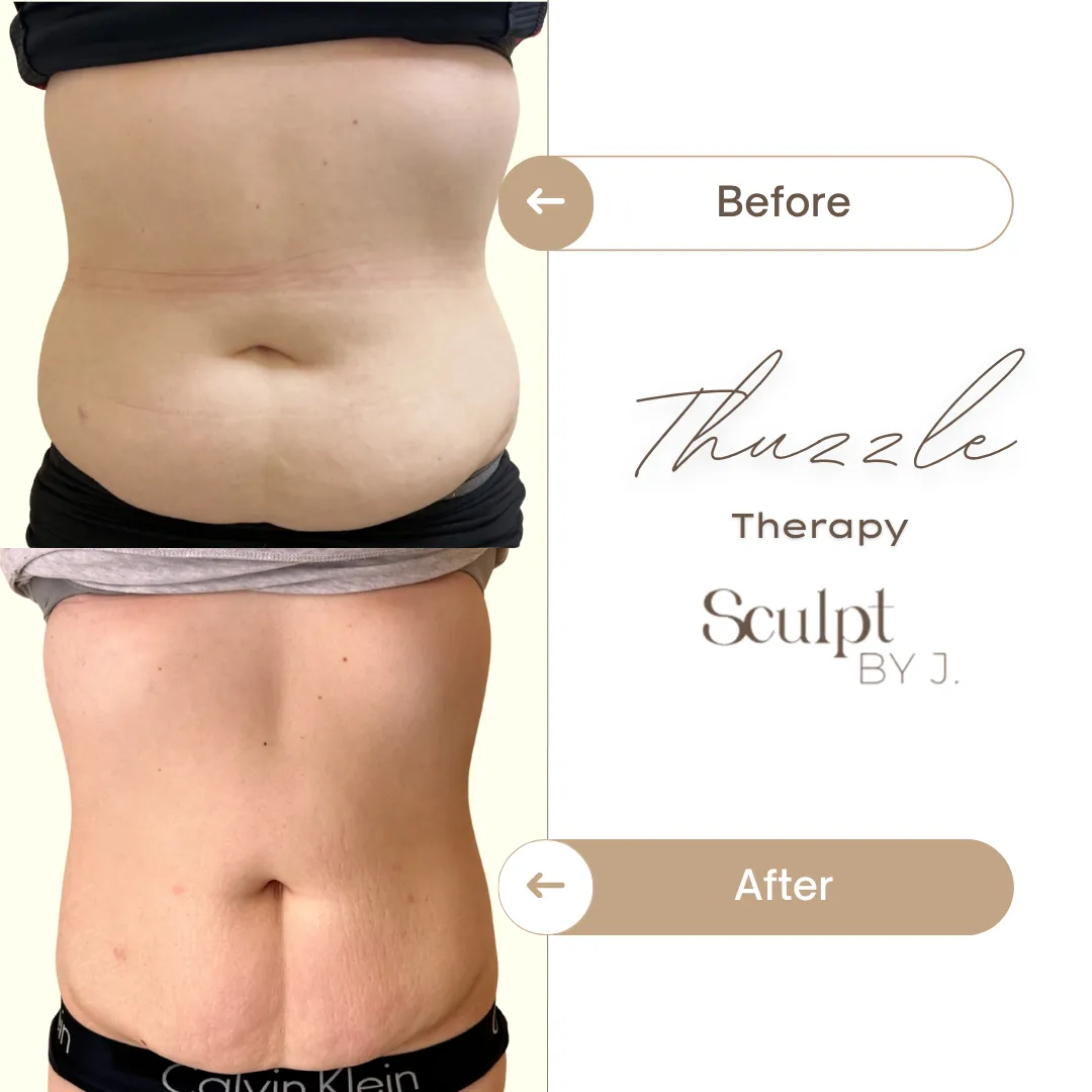 Deep Lipolysis Body Result
