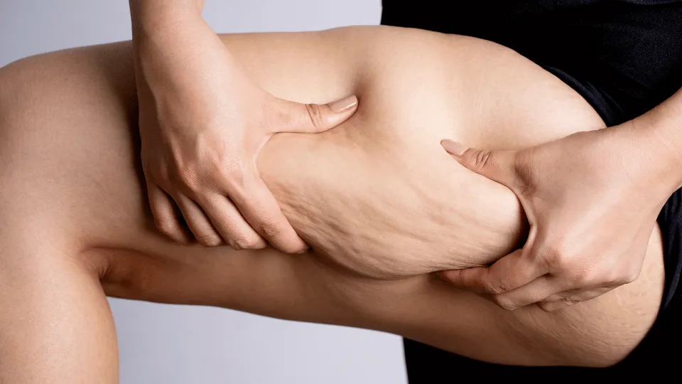 Cellulite