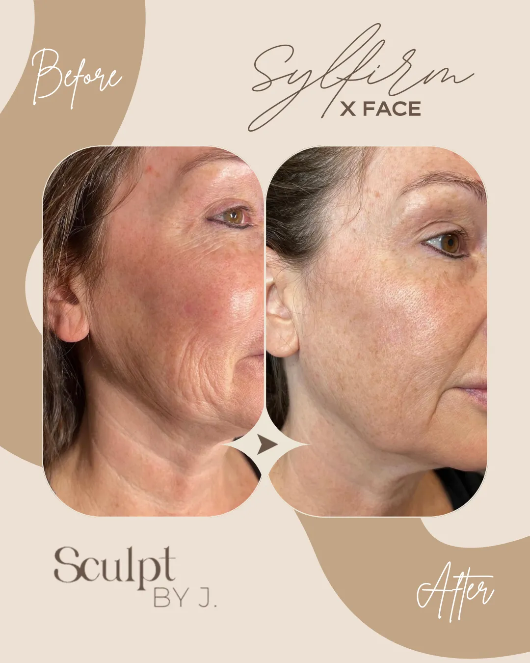 Sylfirm X Facial Rejuvenation