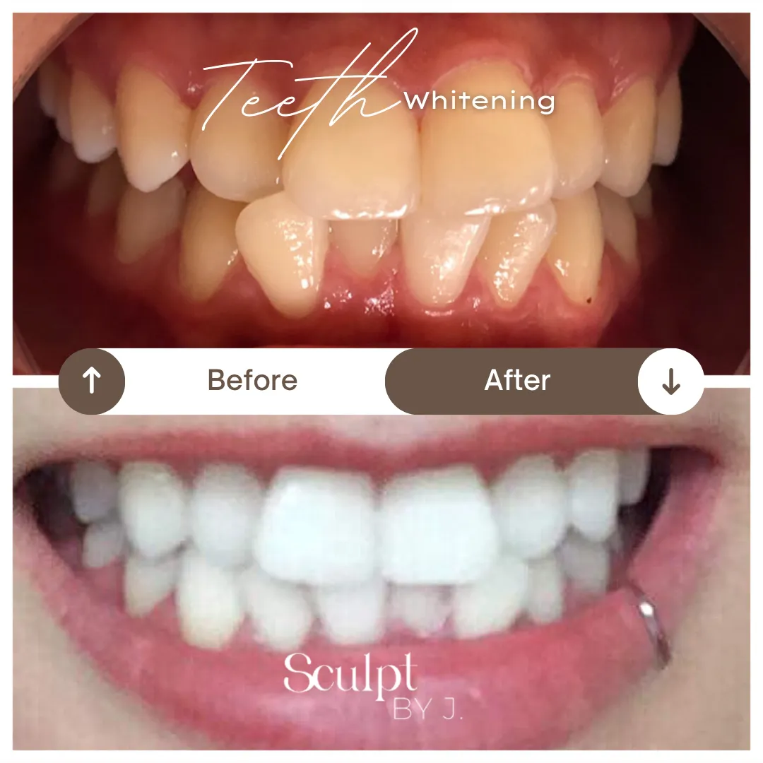 Teeth whitening result case study 3