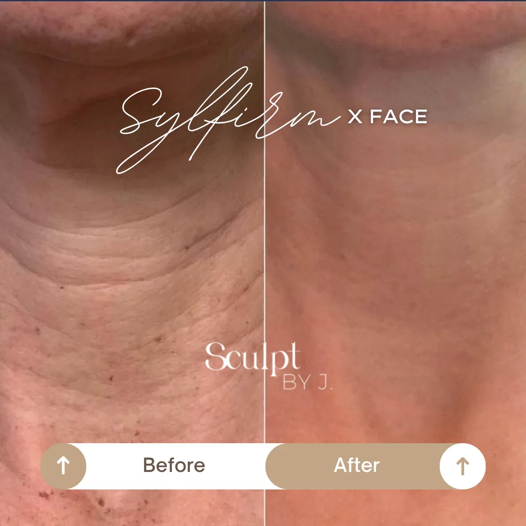Neck and Jawline Tightening