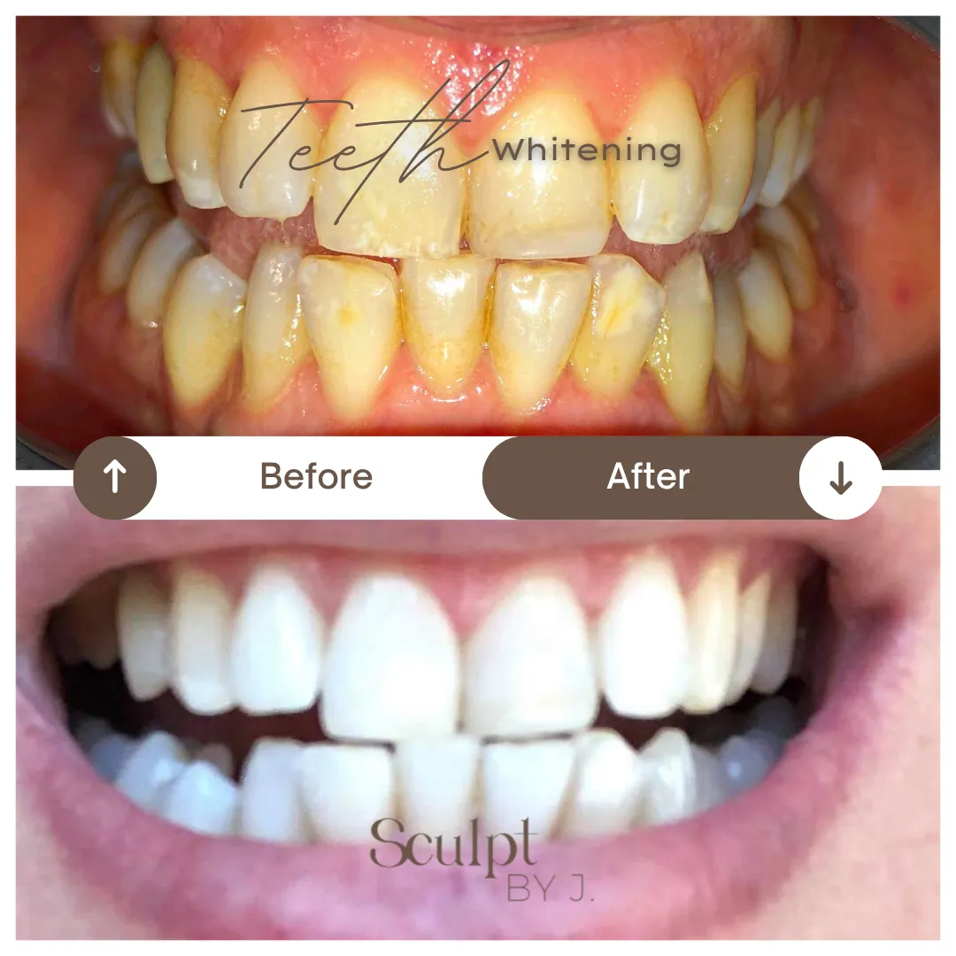 Teeth whitening result case study 1