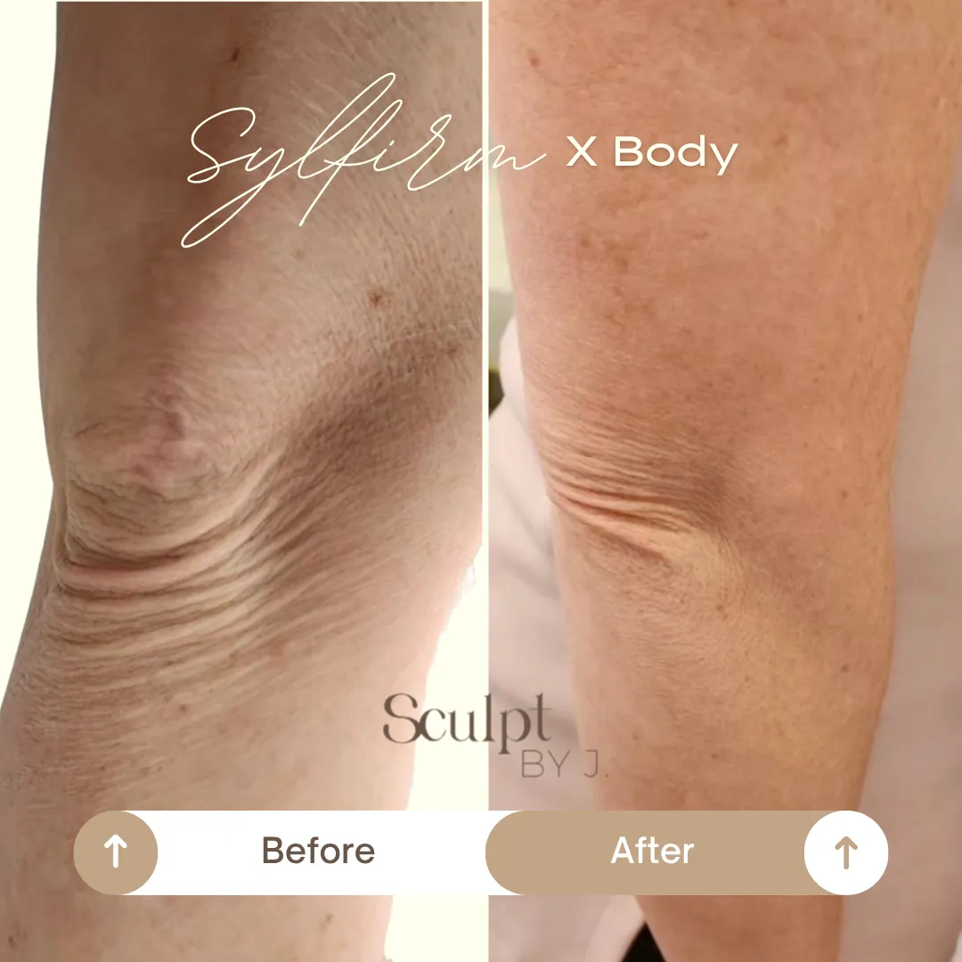 Knee Laxity and Texture Improvement