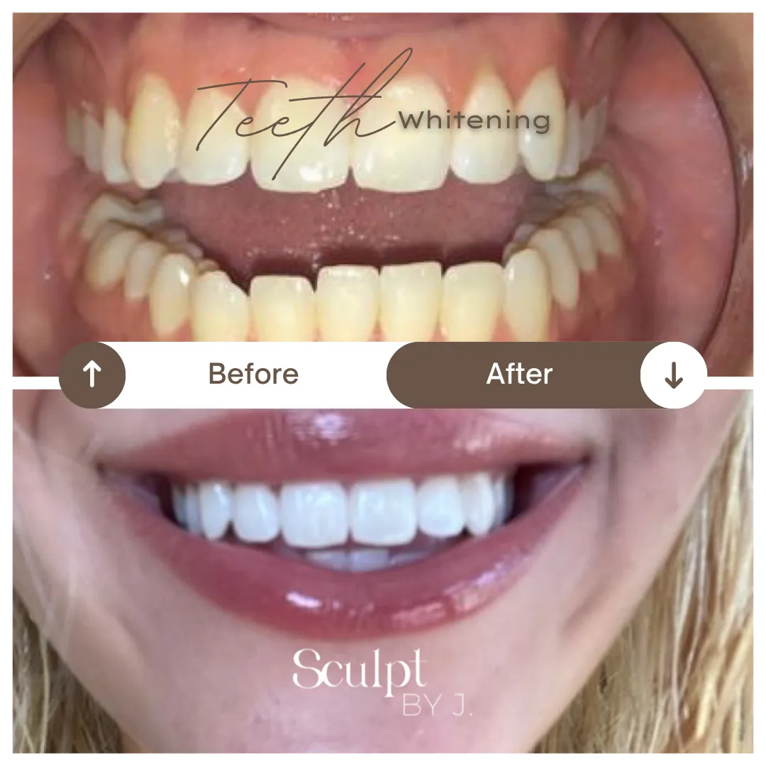 Teeth whitening result case study 2