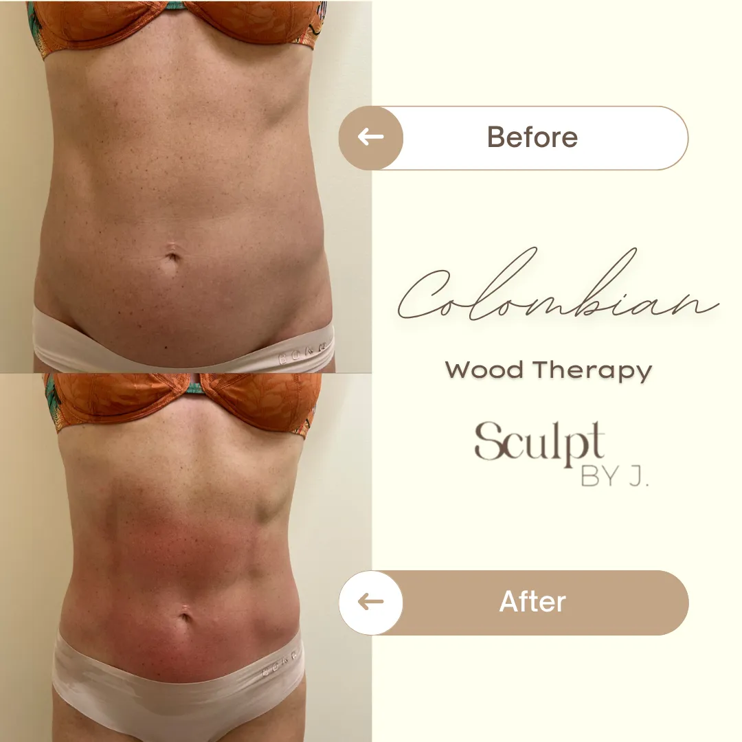 Colombian Wood Therapy