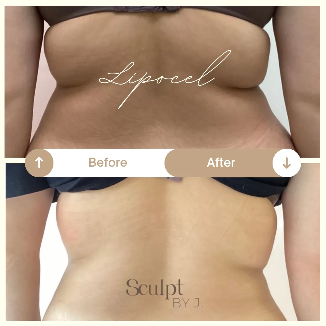 LipoCel Body Contouring