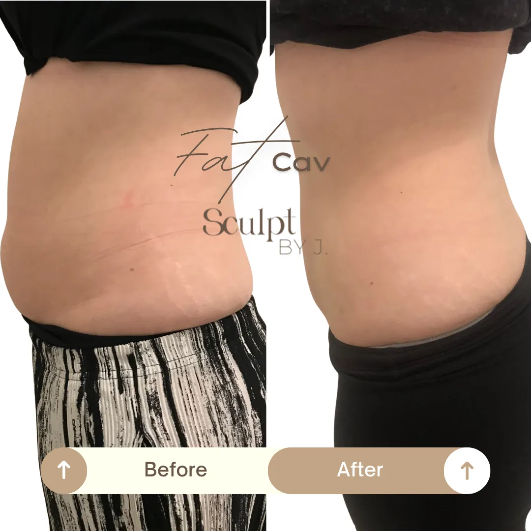 Fat Cavitation