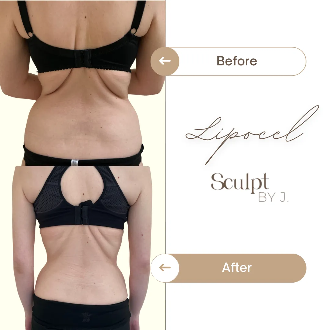 LipoCel Precision