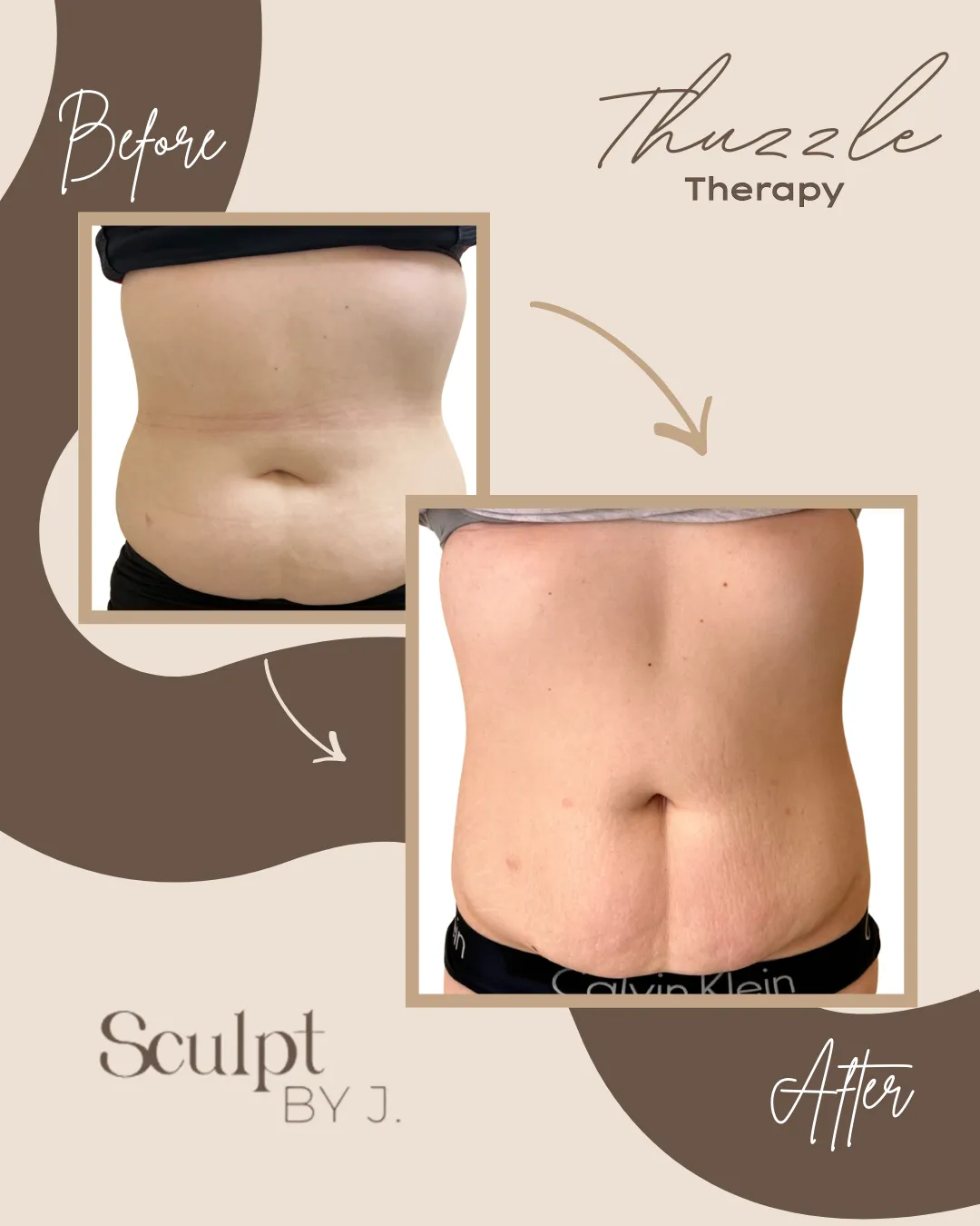 Thuzzle Skin Tightening