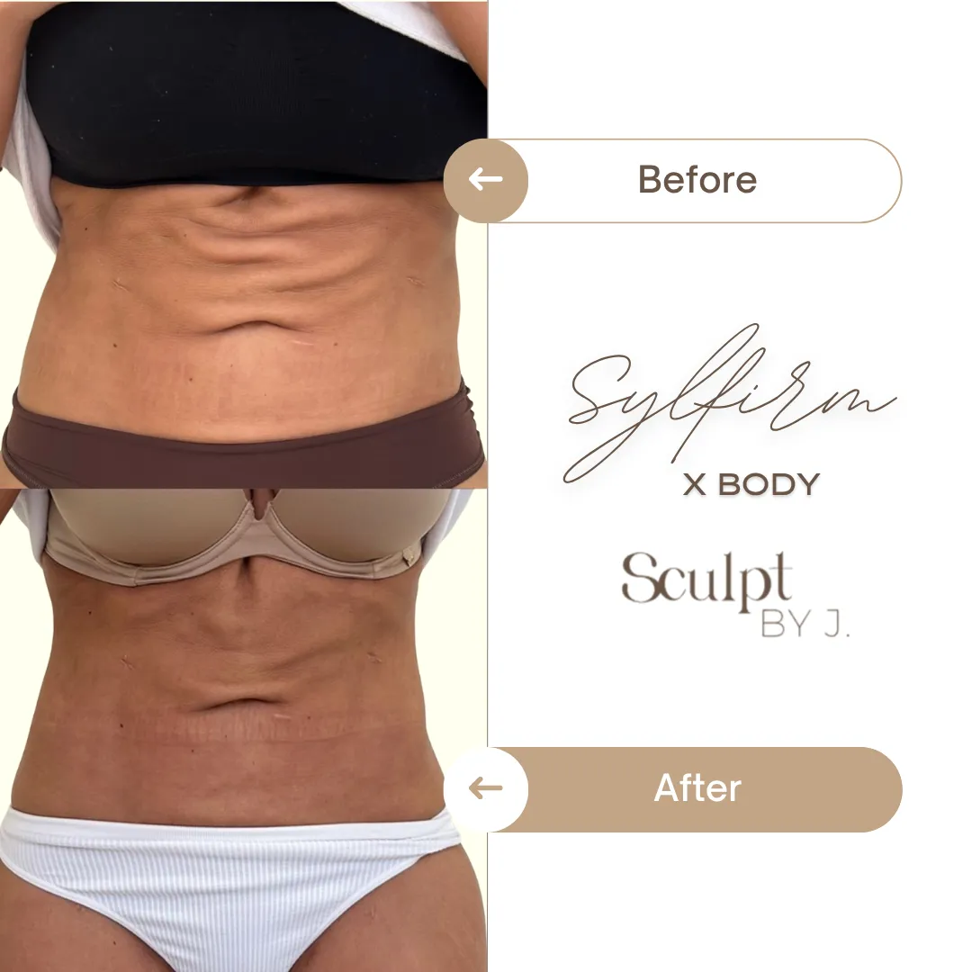 Post-Pregnancy Abdominal Tightening