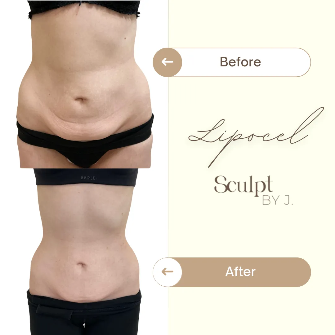 Lipocel Result 1